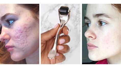 Is <b>derma</b> rolling worth it?. . Derma roller acne scars before and after reddit